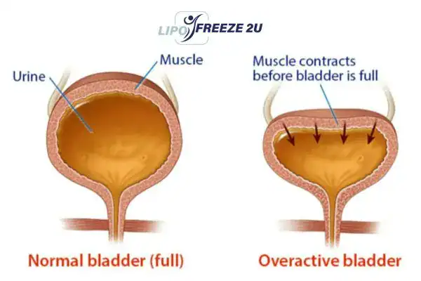 diagram of overactive bladder treatment Market Drayton