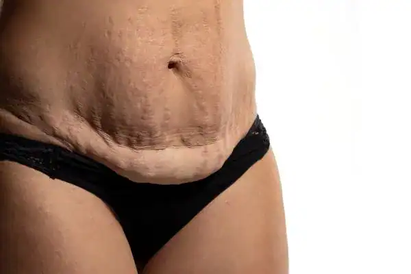 loose skin after weight loss injections Market Drayton