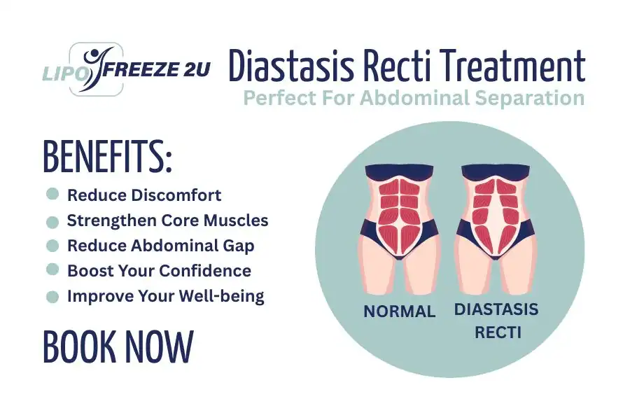 Benefits of body toning treatment Market Drayton for Diastasis recti