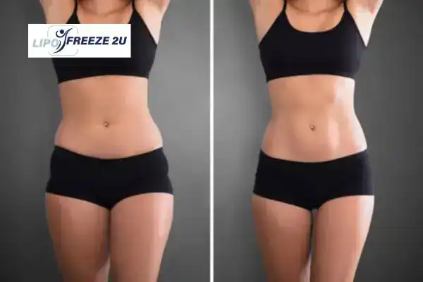 How Can LIPO FREEZE 2U Support Your Post-Pregnancy Body Recovery Market Drayton?