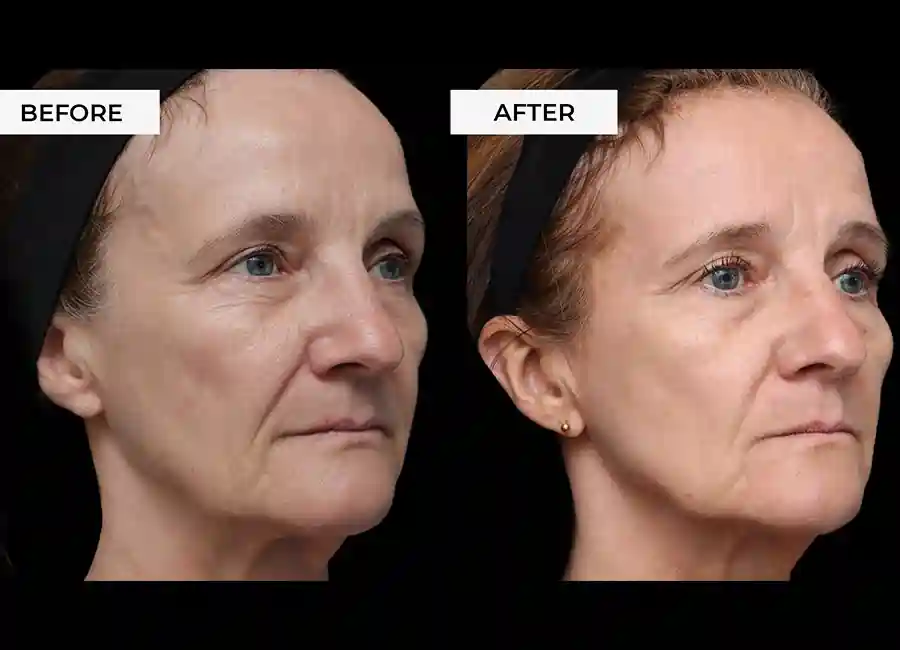 How Many RF Microneedling Sessions Will You Need to See a Difference Market Drayton?