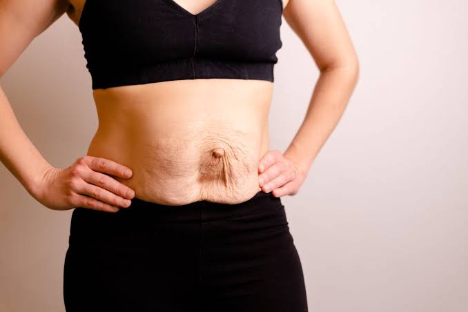 Is Surgery Really the Only Way to Repair Diastasis Recti Market Drayton?