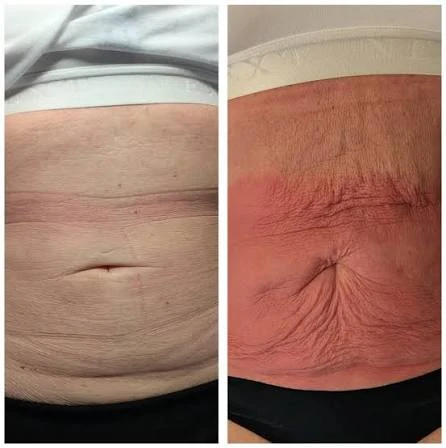 How Does RF Microneedling Improve Crepey, Thin and Uneven Skin Texture Market Drayton?