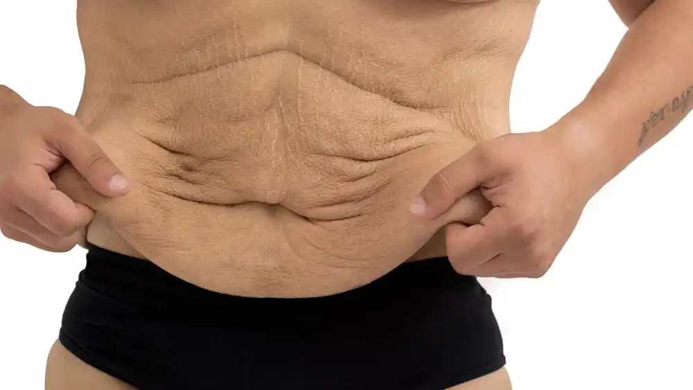 Why Does Weight Loss Medication Leave Some People With Loose or Sagging Skin Market Drayton?